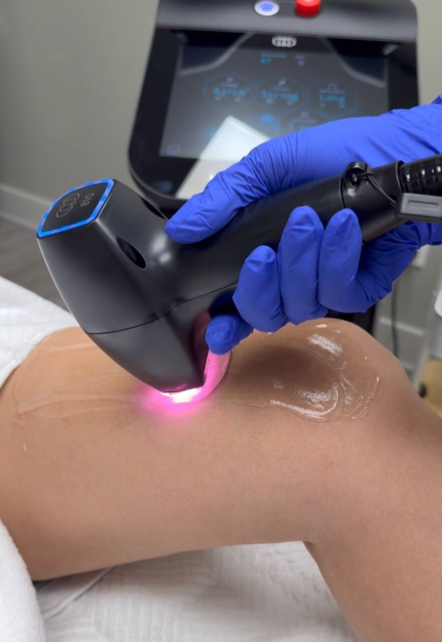 Laser hair removal treatment in progress