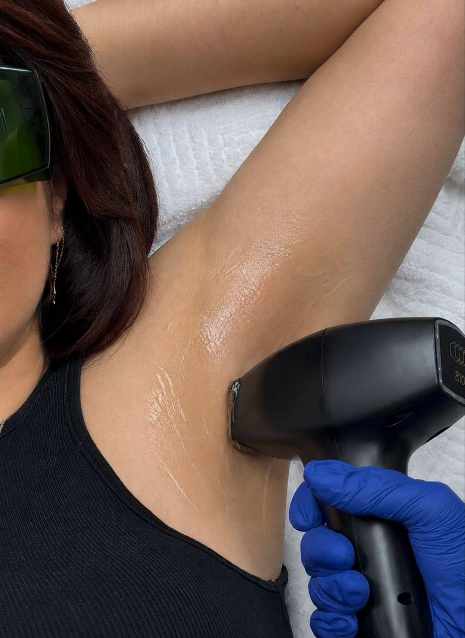 Underarm laser hair removal treatment