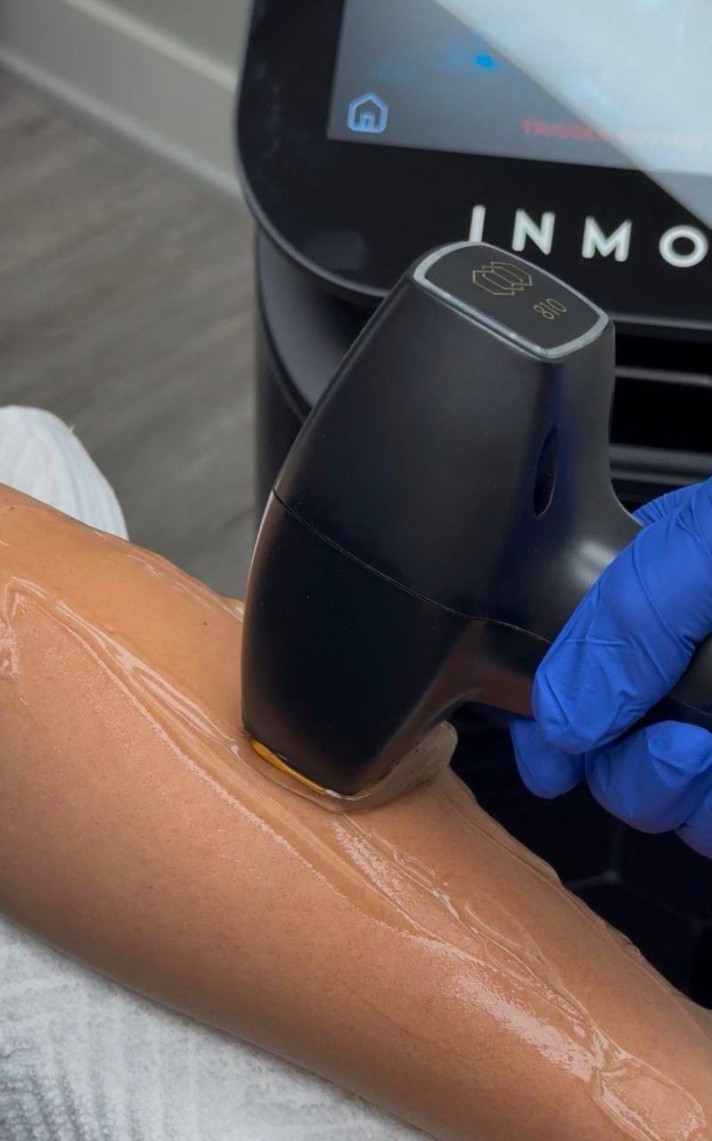 Professional laser hair removal treatment