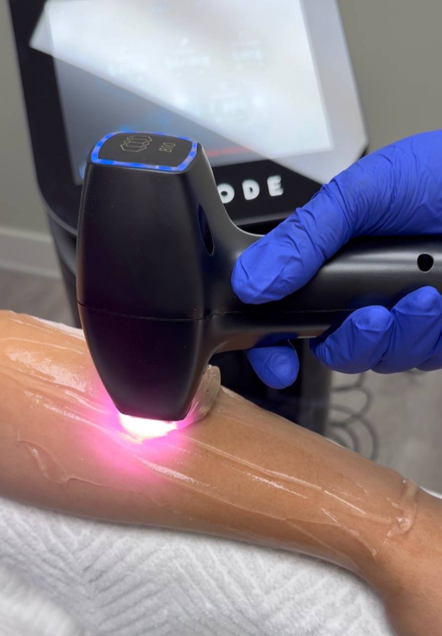 InMode laser hair removal treatment in progress